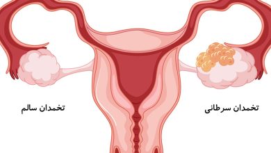 عوارض سرطان تخمدان